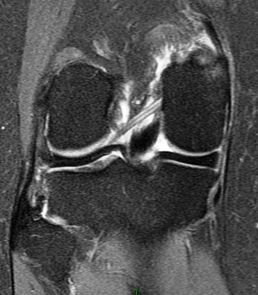 Figure 4 for case Partial tear of the tendon of the medial head of the gastrocnemius muscle ( RID2921 )